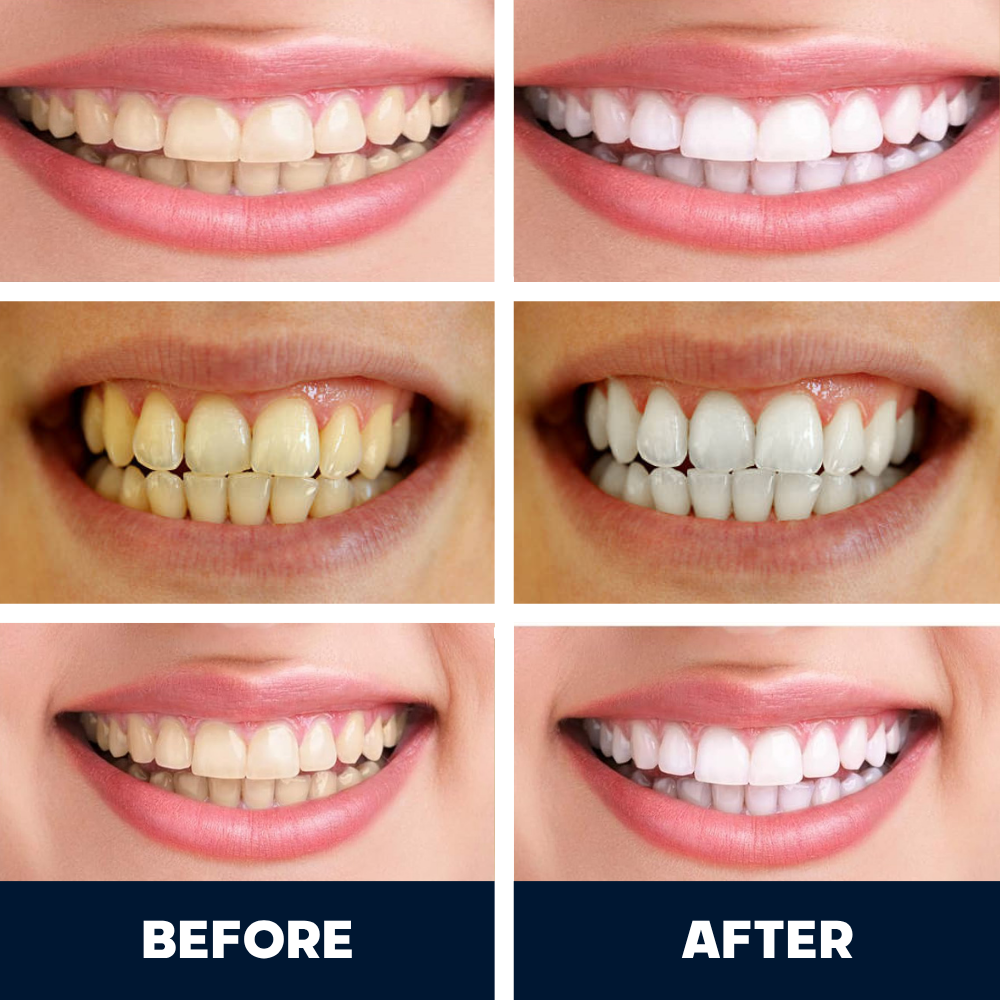 SmilePro™ AutoBrush