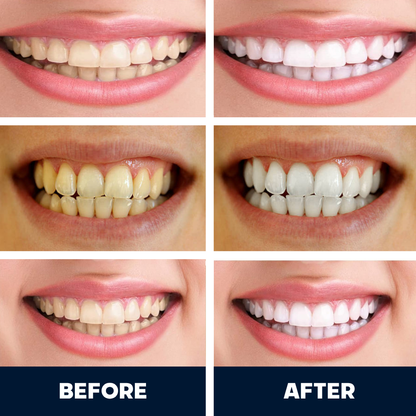 SmilePro™ AutoBrush